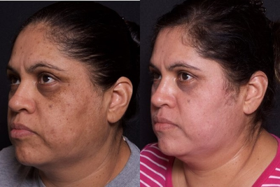 40-49 year old woman treated with Skin Rejuvenation - 40-49 year old woman treated with Skin Rejuvenation
