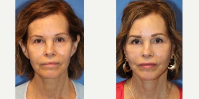 65-74 year old woman treated with Deep Plane Facelift, Eyelid Surgery, Facelift, Earlobe Repair - This 65 year old female presents with signs of facial and eyelid ageing, volume loss and protruding ears since childhood. She underwent deep plane facelift, lower blepharoplasty transconjunctival approach, otoplasty and correction of attached earlobes plus fat grafting. At the time of surgery Dr. Lipschitz removed lower eyelid filler by injecting hyaluronidase. Before and 2 months post op result.
