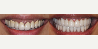 Woman treated with Tooth Repair - Woman treated with Tooth Repair using 28 porcelain restorations (crowns and veneers) to replace 30 year old crowns and gummy smile which bothered her. Root canals were redone as well as gum lift. Patient is shown immediately post-op.