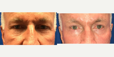 45-54 year old man treated with Eyelid Surgery - This man had heavy tired eyes. We removed the skin of the upper lid with a small muscle flap. He did very well. I apologize for the difference in lighting but pay attention to the skin of the upper lids.