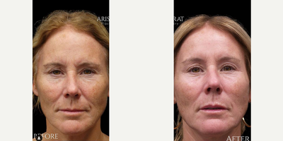 Woman treated with Silhouette InstaLift, Nonsurgical Facelift - Woman treated with Silhouette InstaLift, Nonsurgical Facelift
