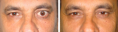 Prosthetic Eye - 
	Before (left) and after (right) socket surgery and prosthesis.
