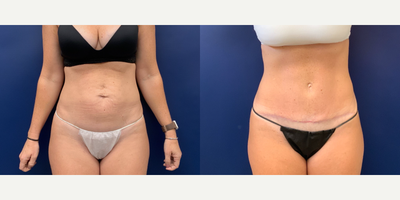 45-54 year old woman treated with Mini Tummy Tuck - Limited TT