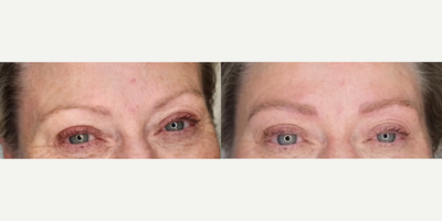 Woman treated with Microblading - Woman treated with Microblading