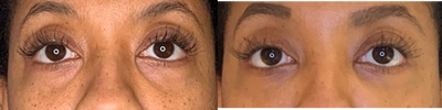 25-34 year old woman treated with Belotero - 2 weeks post Belotero in the tear trough area to get rid of undereye bags on my 33 yo patient. She is extremely happy with her well rested appearance.