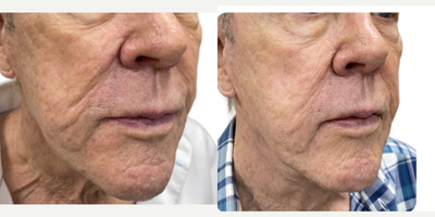 75 and up year old man treated with Renuva - 1 month after renuva