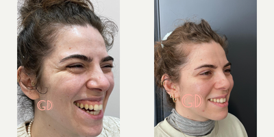 25-34 year old woman treated with Lip Repositioning, Botox for Gummy Smile - Lip repositioning surgery is the most effective method for gummy smile correction. It is usually a permanent procedure and after this surgery you won't need botox for your excessive gum visibility anymore. Lip repositioning surgery not only eliminates gingival visibility, but also reduces the wrinkles of the face and provides botox effect on the face by blocking overactive inner lip muscles. The healing process takes approximately 1 week and it takes approximately 1 month for the results to be fully established.