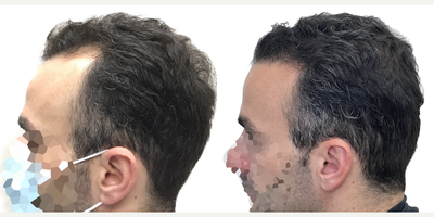 38 year old man treated with Rogaine - This is a 38-year old male with progressive, androgenetic hair loss starting at about age 18. He was on finasteride for about 10 years when it first started but stopped at about age 28 because he just felt that he didnt want to be on oral medication anymore. Unfortunately, though, once he stopped the finasteride, his hair started falling out.More recently hed started daily minoxidil which was working well to prevent any more hair loss, but as expected, it didnt do anything to regrow the deepening recessions on both sides of his hairline. He was seeking restoration with surgery. You can really see those recessions once we shaved his head just prior to getting started. At the same time, he wanted a little more density behind his hairline in the frontal scalp, as well as a few grafts scattered over the crown, just to add a slight bit of density there.He had a 2461 graft FUE, with most of the grafts allotted to filling those recessions on either side of his hairline. We also added a few through the remainder of the frontal scalp and just a small amount in the crown.Hes had a great result! The recessions are restored and his hairline looks really natural! Hes still using his daily minoxidil to prevent ongoing hair loss and this is the kind of restoration that will age with him really naturally for decades to come. Even though we extracted more than 2400 grafts, weve done it in such a way that his donor area still looks really full. Youd really never be able to tell that this patient had a hair transplant!