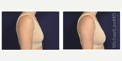 25-34 year old woman treated with Natrelle Breast Implants - Breast augmentation. Follow-up photo taken 3 months after the procedure.