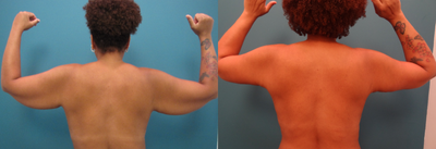 45-54 year old woman treated with Arm Lift- 1 month after surgery - 49 year old Female 5'10 lost 110 pounds and presented with overhanging skin and excess fat in her upper arms. She desired contouring of her upper arms without creating an overly skeletonized and tight appearance. Results are 1 month after surgery.