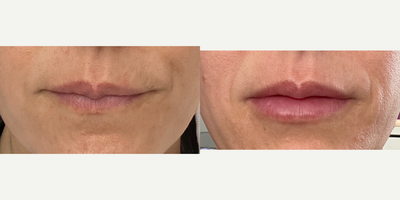40 year old woman treated with Restylane - Lip filler