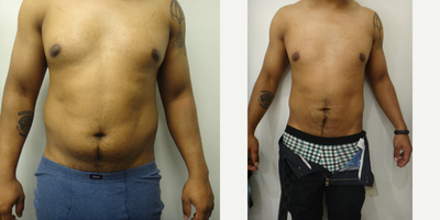 35-44 year old man treated with Slim Lipo - 35-year-old male underwent Slim Lipo Treatment.
