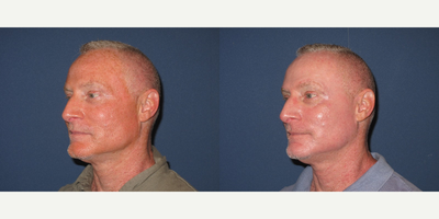 55-64 year old patient treated with CO2 Laser - Patient presented with severe sun spot damage on very fair skin. Co2re Laser procedure was used to give a fresh new look, diminishing the signs of age and sun spots. Treatment was tapered in intensity for the neck area to produce a natural blended appearance.