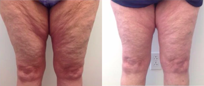 55-64 year old woman treated with Vanquish - This patient is a lovely female patient who wanted to target that stubborn thigh area that has troubled her for sometime. She did the Vanquish ME treatment at The Derm Institute. After 2 sessions she saw results and saw optimal results with 4 sessions. Not only did she have fantastic fat elimination she also had great skin tightening results!