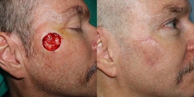 52-year-old man treated with Facial Reconstructive Surgery - V-Y flap reconstruction of cheek