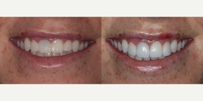 25-34 year old woman treated with KoR Teeth Whitening - KoR Teeth Whitening followed by Porcelain Veneers for front 4 teeth to help brighten up and even smile.