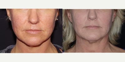 45-54 year old woman treated with Bellafill - Bellafill for acne scarring.
