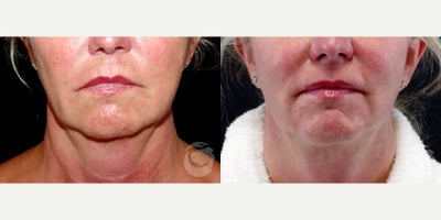 56 year old woman treated with CoolMini to the chin. - 56 year old woman treated with CoolMini to the chin. Photos depict before and 3 months after treatment.