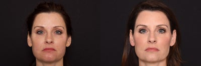 Woman treated with Bellafill - Woman treated with Bellafill