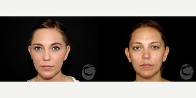 27 year old woman treated with CoolMini to the chin. - 27 year old woman treated with CoolMini to the chin. Photos depict before and 2 months after treatment.