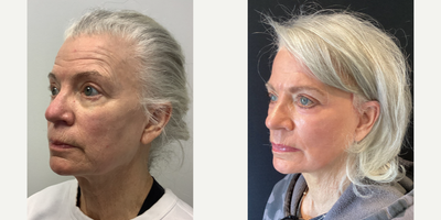 55-64 year old woman treated with QuickLift - Quicklift with Neck Lipo & Laser Resurfacing
