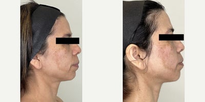 Woman treated with Morpheus8, Lumecca - After 3 sessions of Morpheus8 and 2 sessions of Lumecca, this transformation speaks for itself.