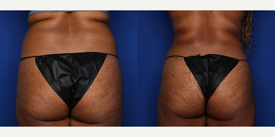35-44 year old woman treated with Liposuction - This 39 year old female was not happy with the appearance of her midsection after 2 kids. We discussed a tummy tuck with some liposuction but she was not interested because of the recovery. We therefore discussed the combination of BodyTite liposuction and Morpheus8 RF microneedling to attempt to get as much skin tightening as possible. She is shown 6 months after BodyTite lipo 360 (abdomen, flanks, bra rolls) along with Morpheus8 RF microneedling to her abdomen. A total of 3 L of fat was removed. She lost ~ 4 inches around her midsection.