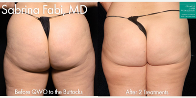 35-44 year old woman treated with Qwo - Qwo injections used to treat cellulite on the buttocks by Dr. Fabi.