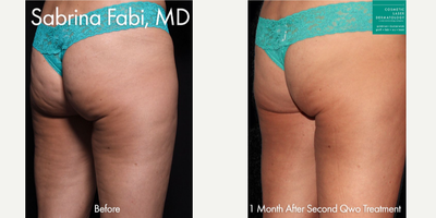 35-44 year old woman treated with Qwo - Qwo injections used to treat cellulite on the buttocks by Dr. Fabi.