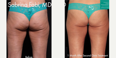 35-44 year old woman treated with Qwo - Qwo injections used to treat cellulite on the buttocks by Dr. Fabi.