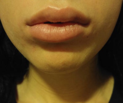 Uneven swelling after lip fillers. Is this normal? (Photo) Doctor ...