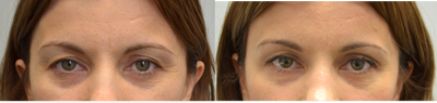 35-44 year old woman treated with Ultherapy brow lift - 35 year old desiring brow lift.