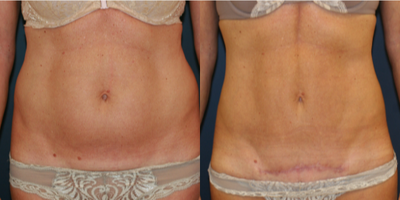 Mini Tummy Tuck Scar - 48 year old Mom before and three months after Mini-Tummy-Tuck. After photo shows lower abdominal healing scar. Steve Laverson MD San Diego Tummy Tuck Plastic Surgeon Specialist