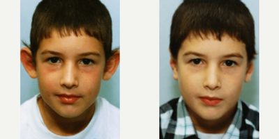 Man treated with Ear Surgery - Man treated with Ear Surgery