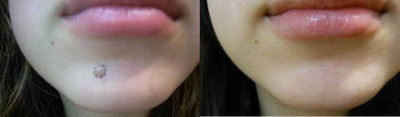Mole Removal - 	Surgical mole removal