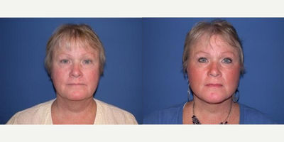 Woman treated with Neck Lift - This woman requested neck rejuvenation. She was unhappy with not only the excess skin of her neck, but the poor definition of her jawline and neckline. I performed a necklift and addressed not only the excess skin but the underlying tissues in order to obtain a natural result, seen here at 3 weeks after surgery.