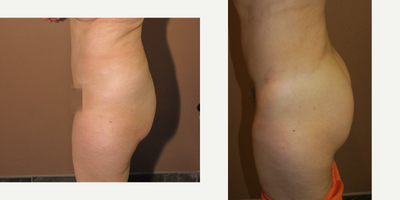 55-64 year old woman treated with Brazilian Butt Lift - belt lipectomy and brazilian buttock lift