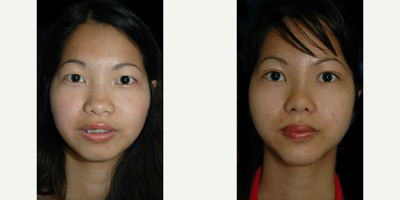 25-34 year old woman treated with Genioplasty, Rhinoplasty - 25-34 year old woman treated with Genioplasty, Rhinoplasty