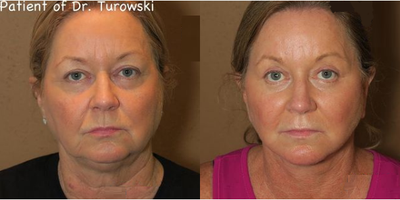 Woman treated with Buccal Fat Removal - Woman treated with Buccal Fat Removal