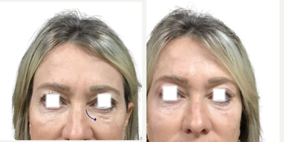 45-54 year old woman treated with Aquagold, Facial - REVIVIFY TREATMENT USING AQUAGOLD FINE TOUCH