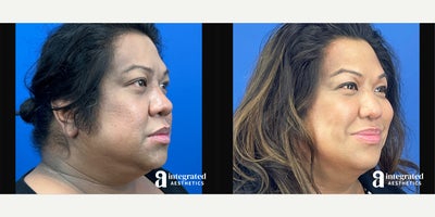 35-44 year old woman treated with AccuTite, Thread Lift, Facial Fat Transfer, Rhinoplasty, Buccal Fat Removal - The patient is a 42-year-old transgender female who has concerns with the appearance of her lower, face, neck, and nose. Dr. Cho performed Accutite and MyEllevate to the lower face and neck, fat grafting to the face, Alar Width and Internal Nare Reduction to the nostrils, and buccal fat removal. The after results are 4 months post-procedure.