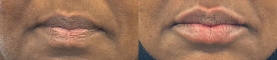 Woman treated with Lip Fillers - Woman treated with Lip Fillers