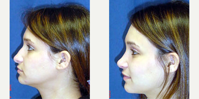 Woman treated with Rhinoplasty - Woman treated with Rhinoplasty