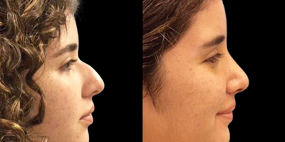 18-24 year old woman treated with Rhinoplasty - Rhinoplasty