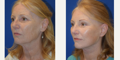 65-74 year old woman treated with Lower Face Lift - 65-74 year old woman treated with Lower Face Lift
