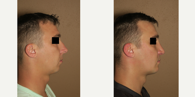 35-44 year old man treated with Chin Implant - chin augmentation and rhinoplasty