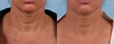 Woman treated with Vivace - Woman treated with Vivace micro needling.