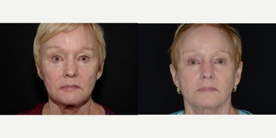 73 year old woman treated with Silhouette InstaLift - 73 year old woman treated with Silhouette InstaLiftPhotos depict before and 9 months after surgery.