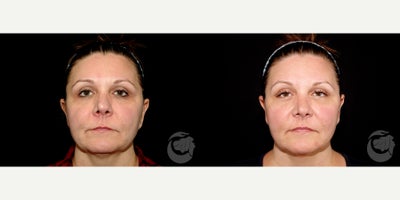 45-54 year old woman treated with Thread Lift - 47 year old Female treated with 10 SIlhouette Instalift sutures