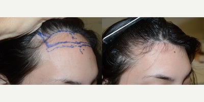 25-34 year old woman treated with Forehead Reduction - Before and 3 months after a hairline lowering/forehead reduction surgery.